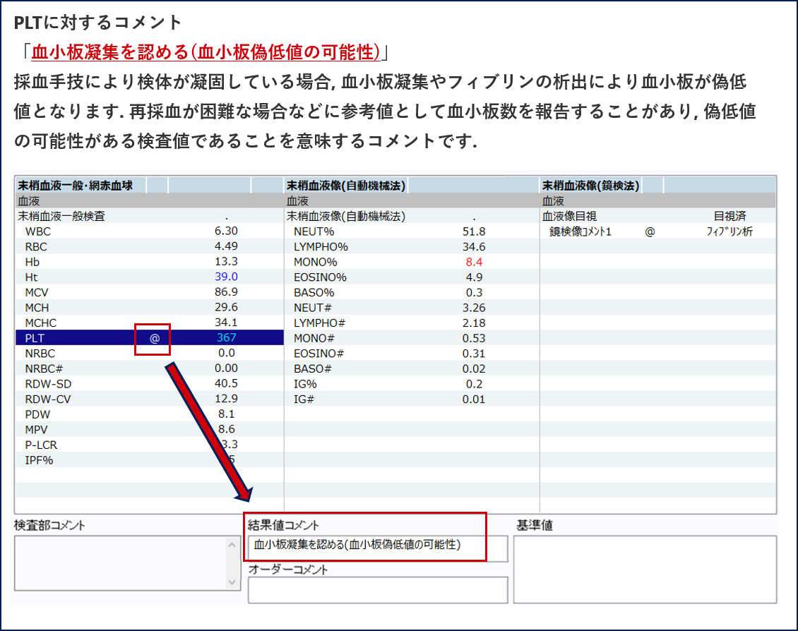 @コメントの意義<br />「血小板減少を認める(血小板偽低値の可能性)」