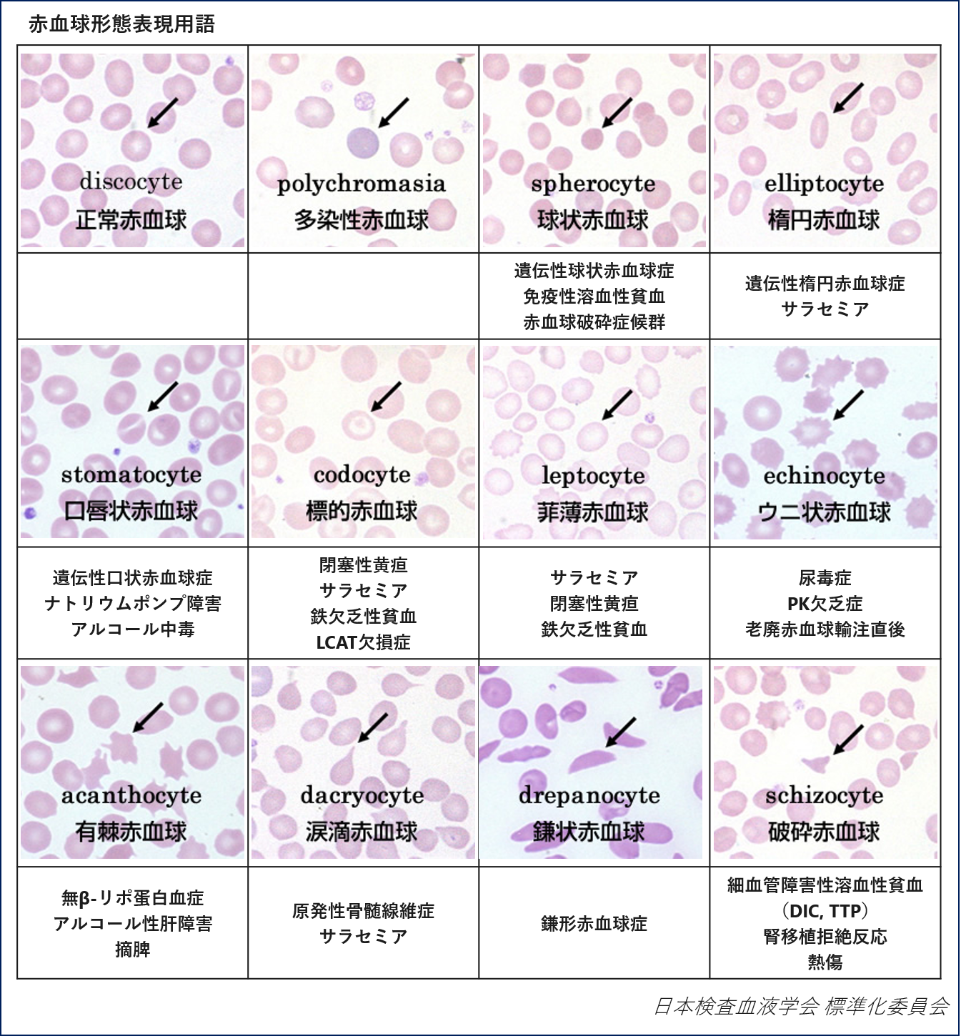 赤血球形態表現用語